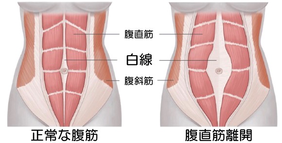 腹直筋離開（ふくちょくきんりかい）の画像